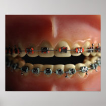 A dental model and Teeth braces Print