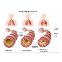 Any size Lung disease Asthma Poster