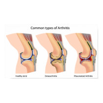 Arthritis Poster