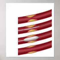 Balloon angioplasty procedure  Poster