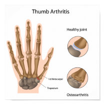 Base of thumb arthritis Poster