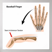 Baseball Finger