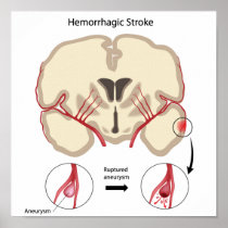Brain hemorrhagic stroke Poster