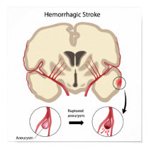 Brain hemorrhagic stroke Poster
