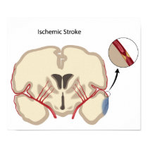 Brain ischemic stroke Poster