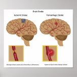 Brain stroke any size Poster posters
