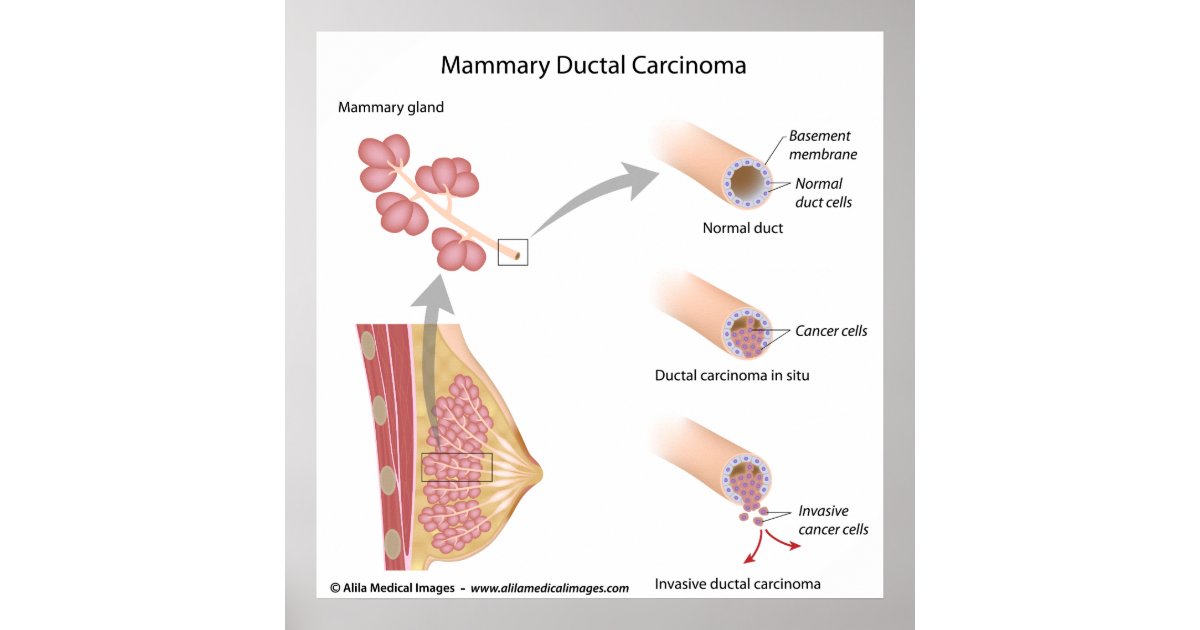 Breast Cancer Ductal Carcinoma   Labeled Diagram  Poster