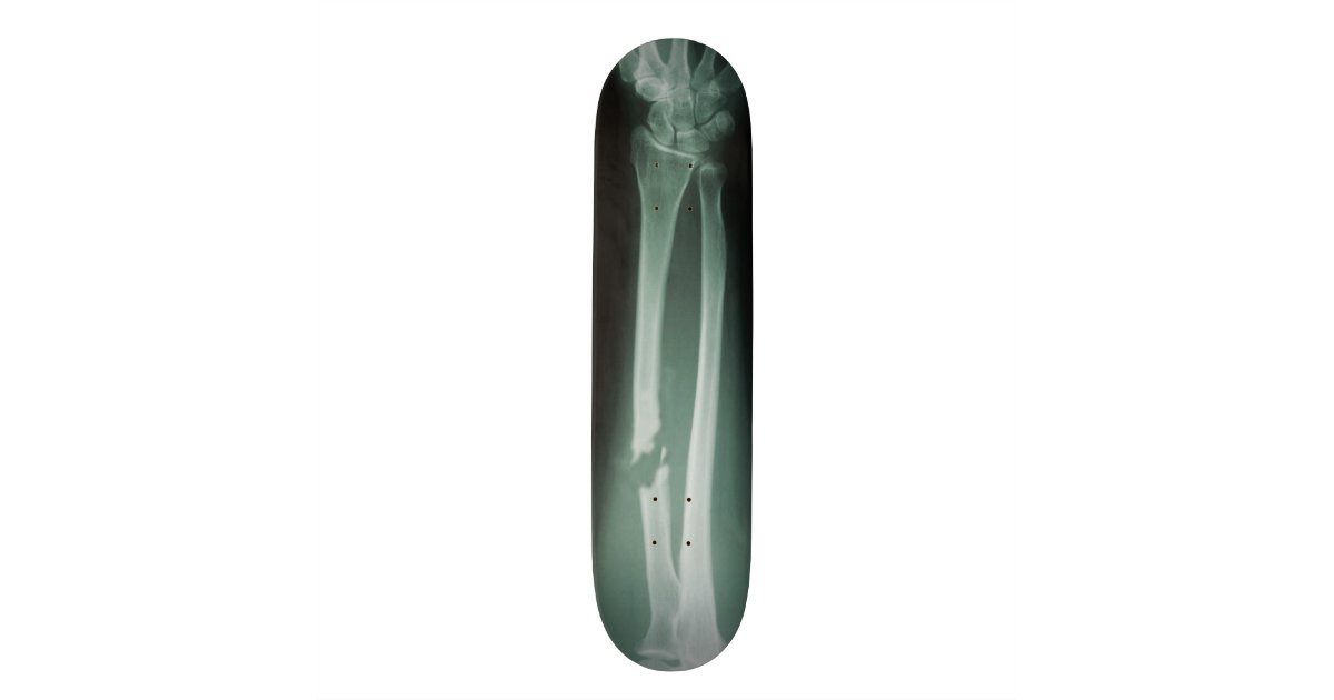 Broken Bones Skateboard Deck Zazzle