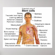 Chart of Potential Uses for Stem Cell Treatments Posters