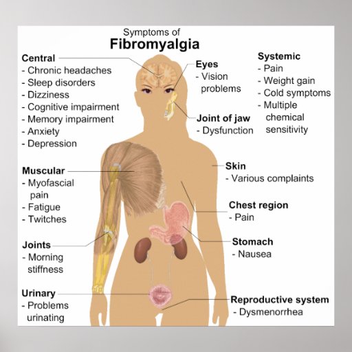 Chart Of The Symptoms Of Fibromyalgia Posters Zazzle 2260