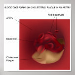 Cholesterol plaque Any size Poster posters