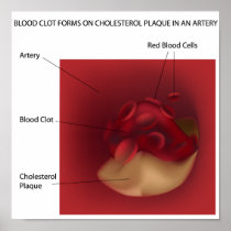 Cholesterol plaque Poster