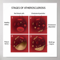 Cholesterol plaque stages Poster