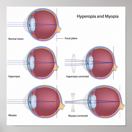 common-eye-defects-poster-zazzle