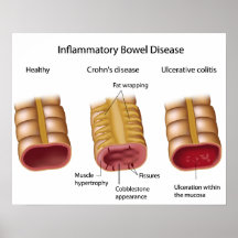 comparing inflammatory bowel diseases poster