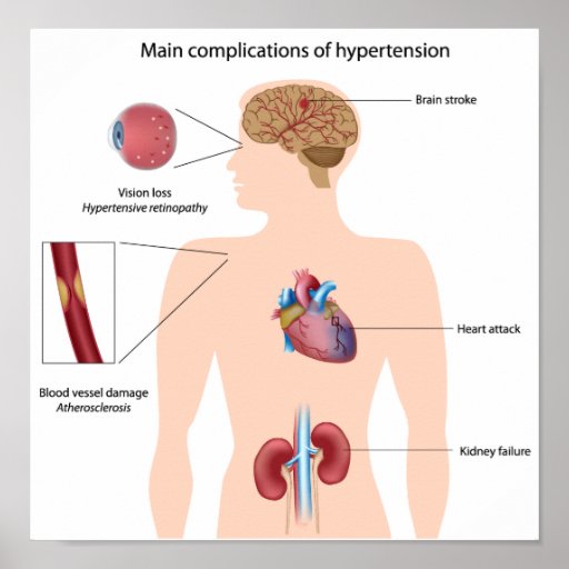 HYPERTENSION COMPLICATIONS hypertension complications: