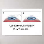 Conductive Keratoplasty (NearVision CK) Poster