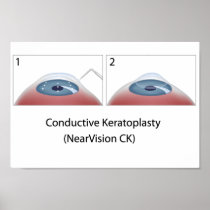 Conductive Keratoplasty (NearVision CK) Poster