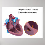 Congenital heart disease Any size Poster posters
