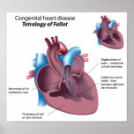 Congenital heart disease Any size Poster posters