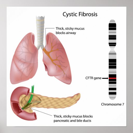 Cystic fibrosis essay