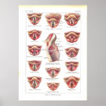Diseases of Larynx Anatomy Poster French