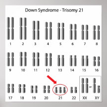 Down syndrome karyotype Poster