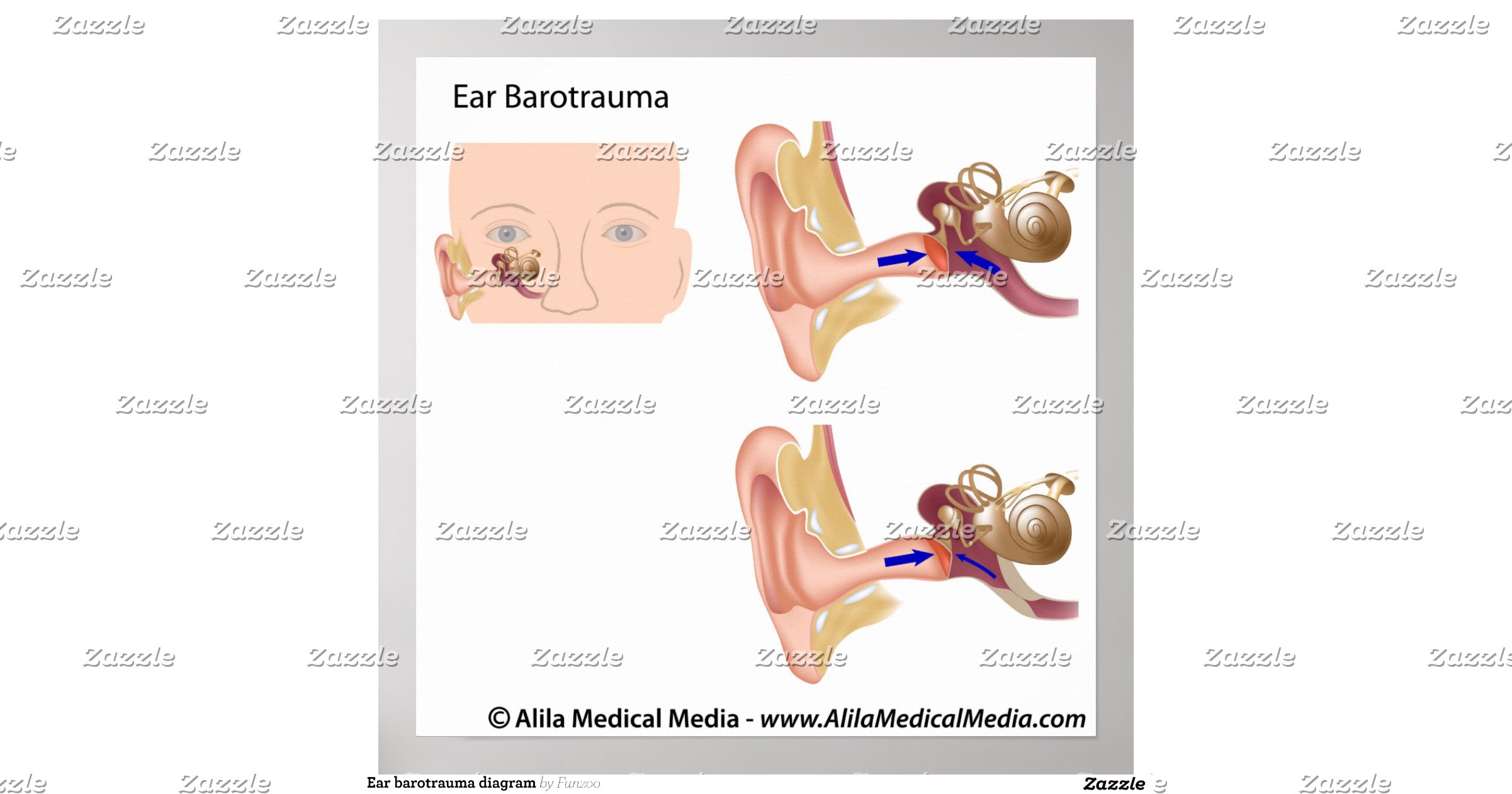 ear_barotrauma_diagram_posterr19fff0482edf44c39643264078205b3b_wvp