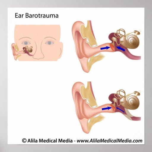 Ear barotrauma diagram poster Zazzle