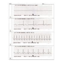 ekg Rhythms posters