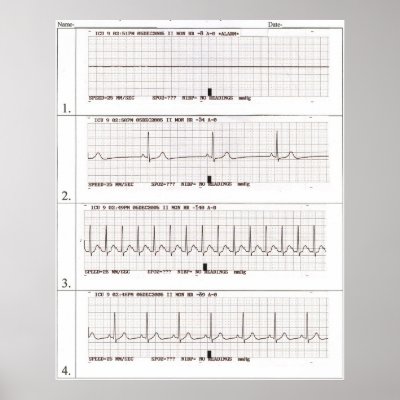 ekg rhythms