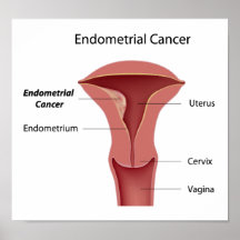 Endometrial cancer Poster