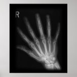 Extra Digit X-ray Right Hand Print