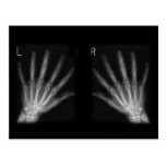 Extra Digit X-ray Right & Left Hands Post Cards