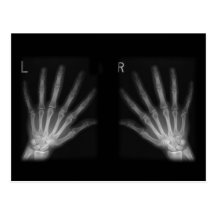 Extra Digit X-ray Right & Left Hands Post Cards