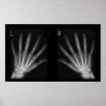 Extra Digit X-ray Right & Left Hands Print