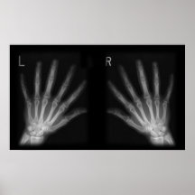 Extra Digit X-ray Right & Left Hands Print