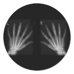 Extra Digit X-ray Right & Left Hands Round Sticker