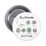Fibromyalgia is real. fMRI proof Pinback Buttons