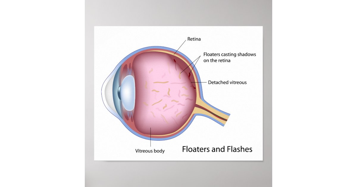 Floaters and Flashes eye disease Poster Zazzle