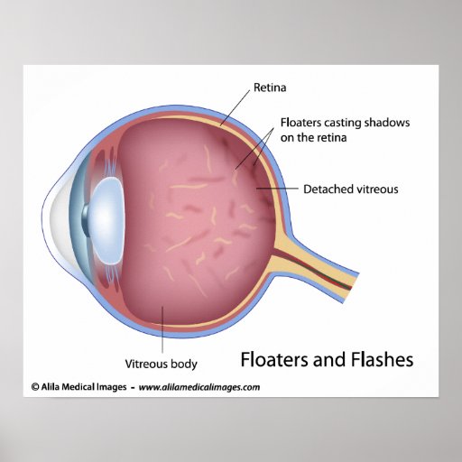 Floaters and Flashes, labeled diagram. Poster Zazzle
