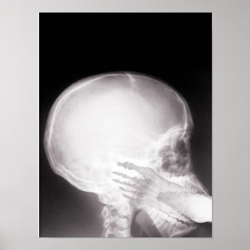 Foot in Mouth X-Ray Print