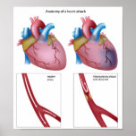 Heart attack Any size Poster posters