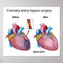 Heart bypass surgery  Poster