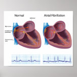 Heart disease atrial fibrillation Any size Poster posters