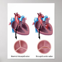 Heart valve defect Poster