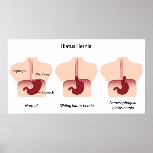Hiatus hernia Poster Zazzle