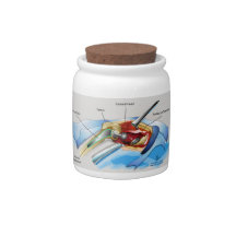 Hip Replacement Infographic candy jar
