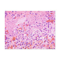 Histopathology of Lung in Fatal Human Plague Post Cards