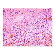 Histopathology of Lung in Fatal Human Plague Post Cards